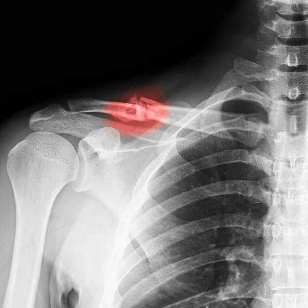 Red Light Therapy for Bone Recovery - Rejuvenate & Heal, Red Light Therapy, Health & Beauty